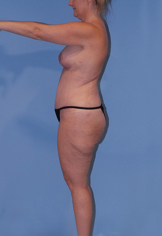 Abdominoplasty Before & After Image