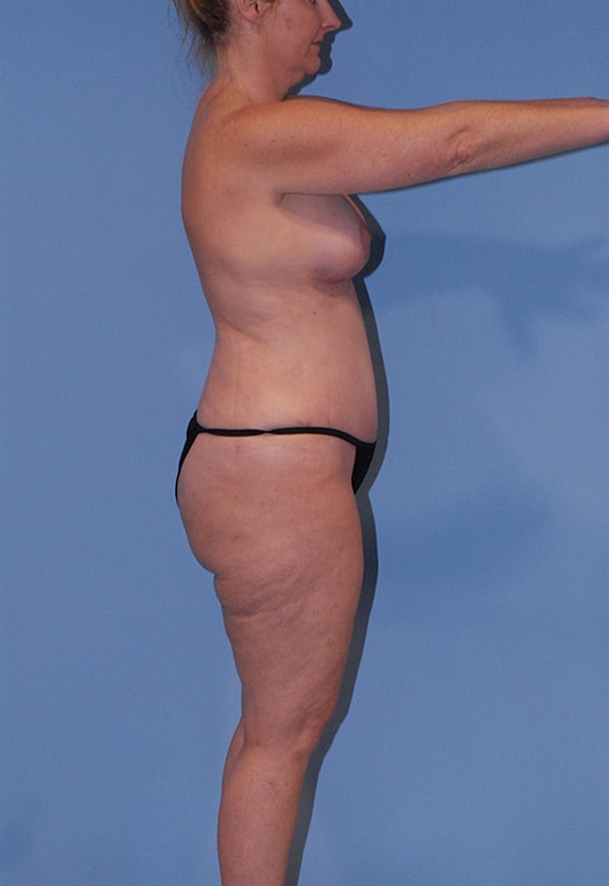 Abdominoplasty Before & After Image