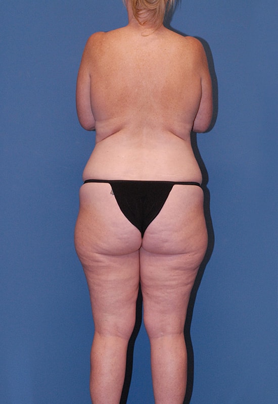 Abdominoplasty Before & After Image