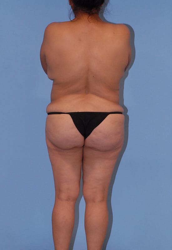 Abdominoplasty Before & After Image