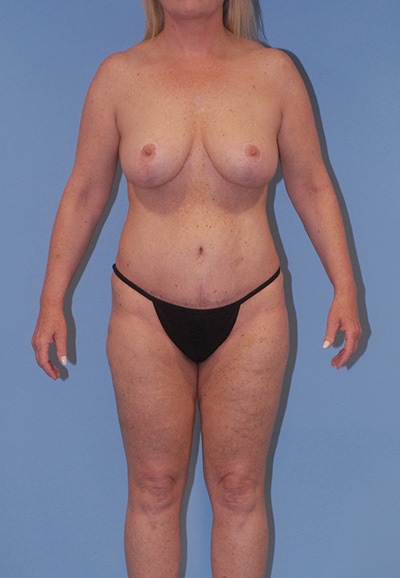 Abdominoplasty Before & After Image