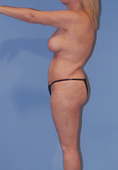 Abdominoplasty Before & After Image
