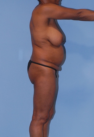 Abdominoplasty Before & After Image
