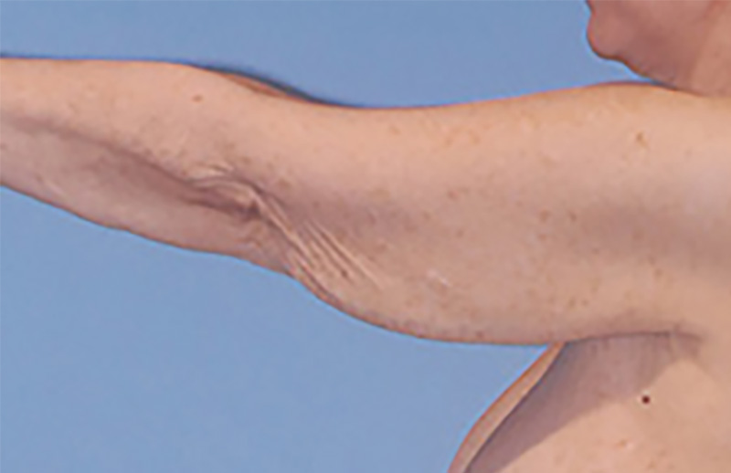 Arm Lift Before & After Image