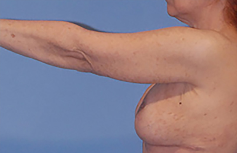 Arm Lift Before & After Image