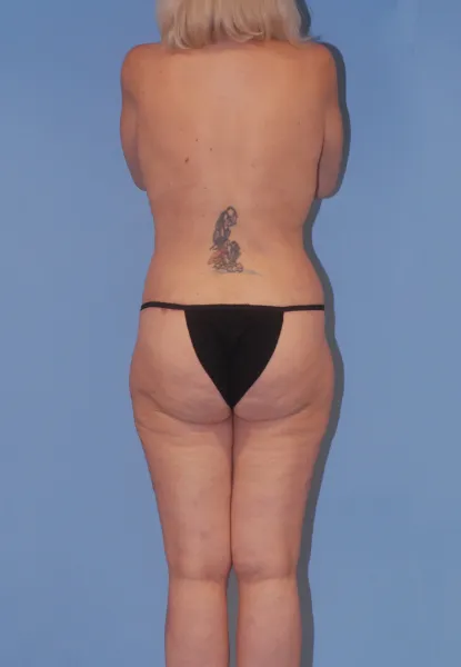 Body Lift Before & After Image