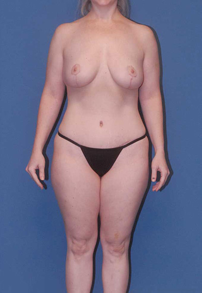 Brazilian Butt Lift Before & After Image