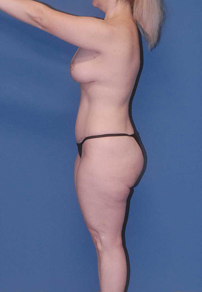 Brazilian Butt Lift Before & After Image