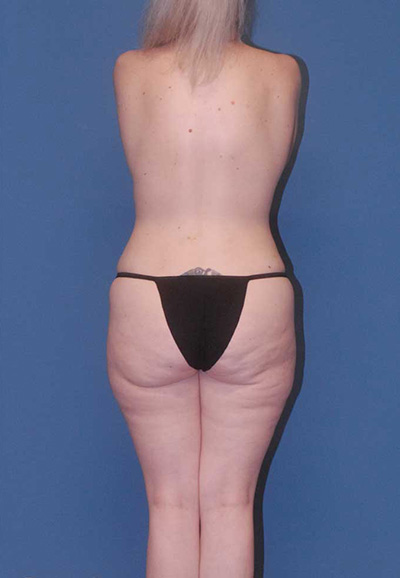 Brazilian Butt Lift Before & After Image