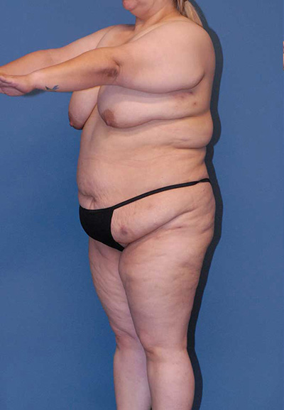 Brazilian Butt Lift Before & After Image