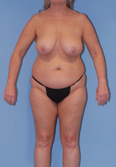 Brazilian Butt Lift Before & After Image