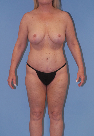 Brazilian Butt Lift Before & After Image