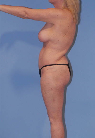Brazilian Butt Lift Before & After Image