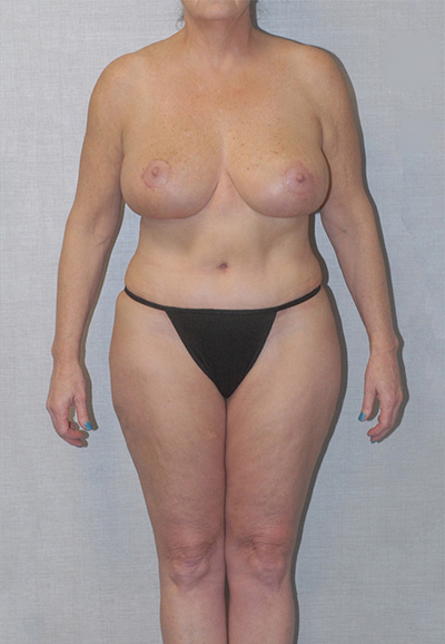 Brazilian Butt Lift Before & After Image