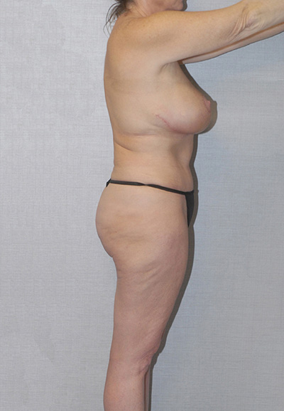 Brazilian Butt Lift Before & After Image