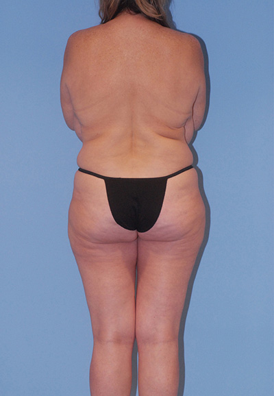 Brazilian Butt Lift Before & After Image