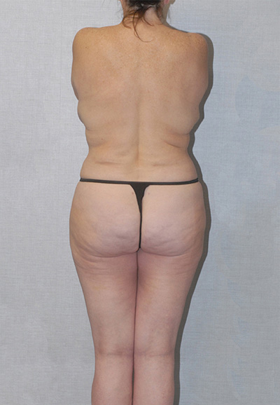 Brazilian Butt Lift Before & After Image