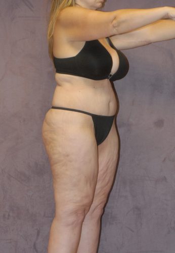 Corrective Body Contouring  Before & After Image