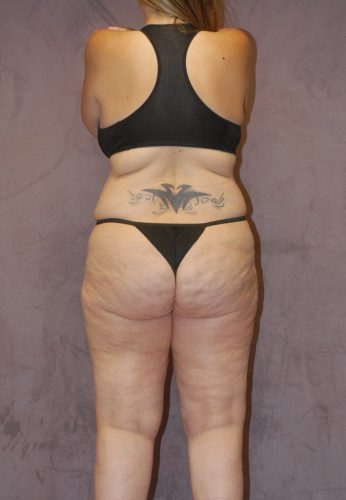 Corrective Body Contouring  Before & After Image