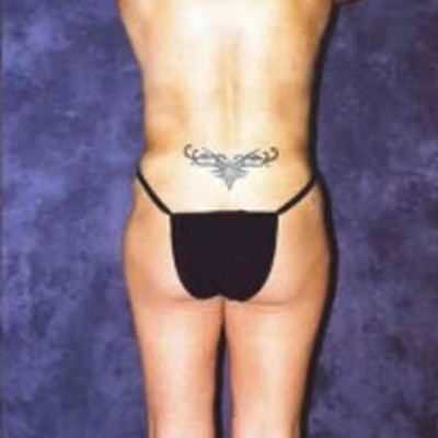 Liposuction Before & After Image