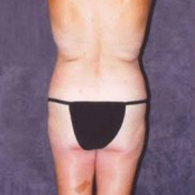 Liposuction Before & After Image