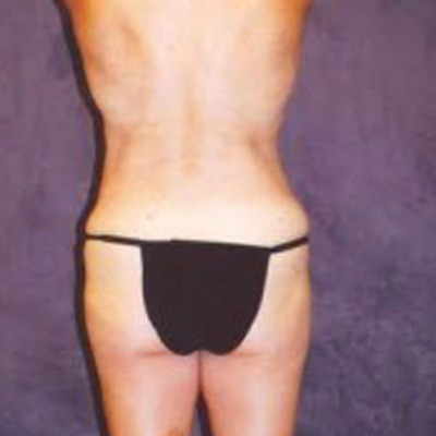 Liposuction Before & After Image