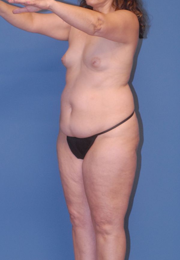 Liposuction  Before & After Image