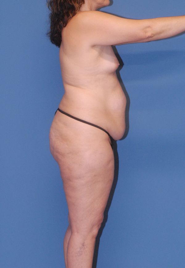 Liposuction  Before & After Image