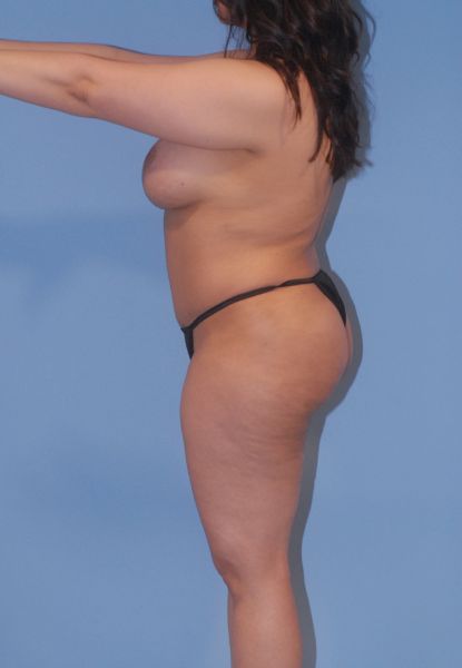 Liposuction  Before & After Image