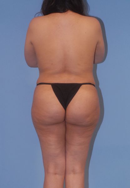 Liposuction  Before & After Image