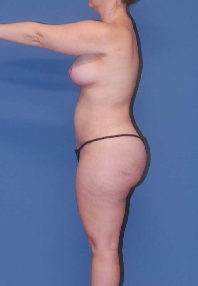 Liposuction  Before & After Image