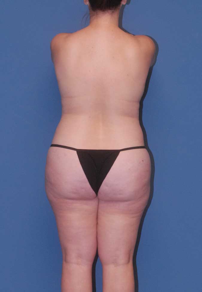 Liposuction  Before & After Image