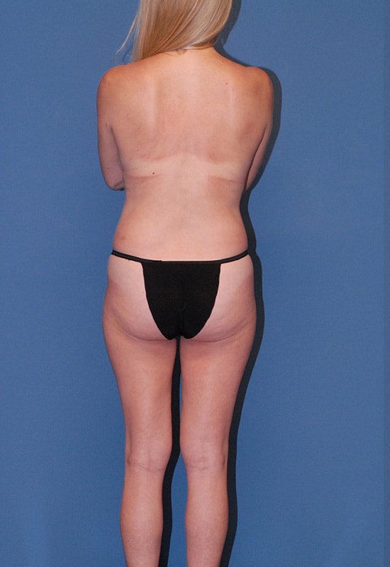 Liposuction  Before & After Image