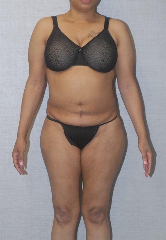 Liposuction  Before & After Image