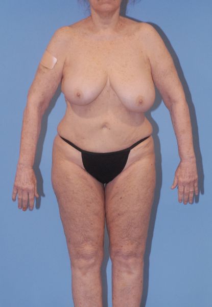 Liposuction  Before & After Image