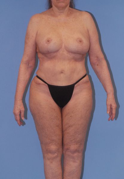 Liposuction  Before & After Image