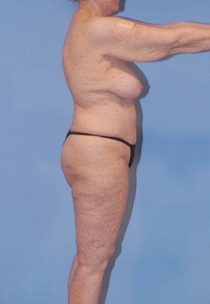 Liposuction  Before & After Image