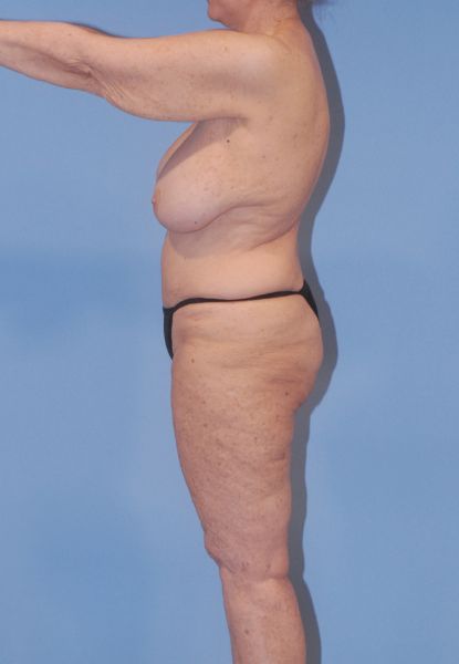 Liposuction  Before & After Image