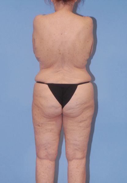 Liposuction  Before & After Image