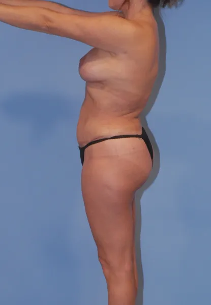 Liposuction  Before & After Image