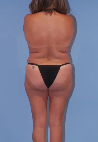 Liposuction  Before & After Image