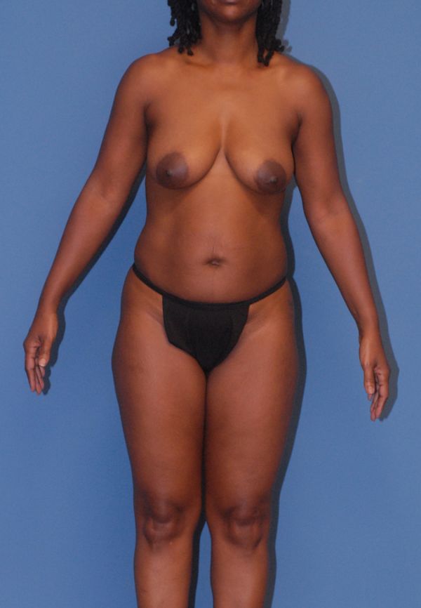 Liposuction  Before & After Image