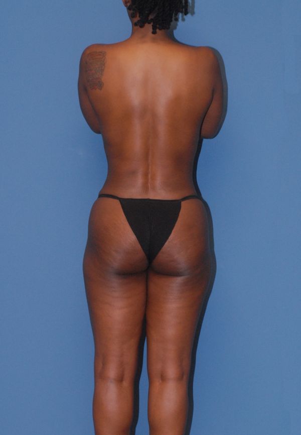 Liposuction  Before & After Image