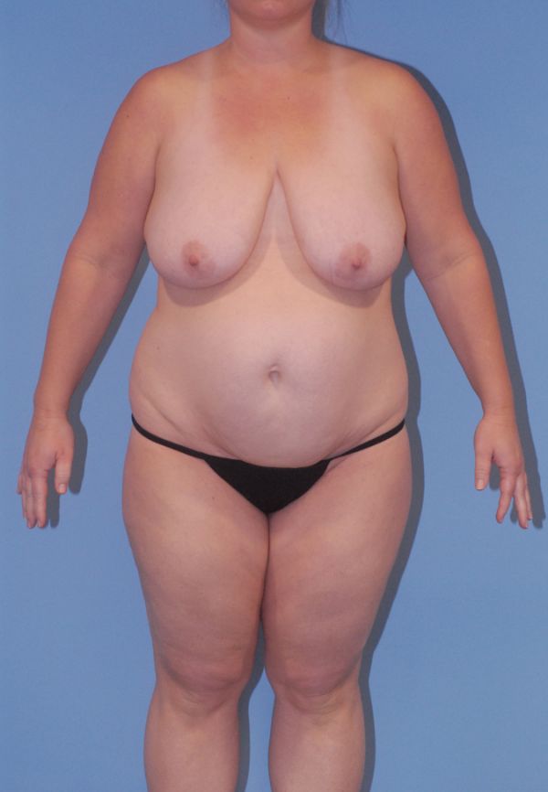 Liposuction  Before & After Image