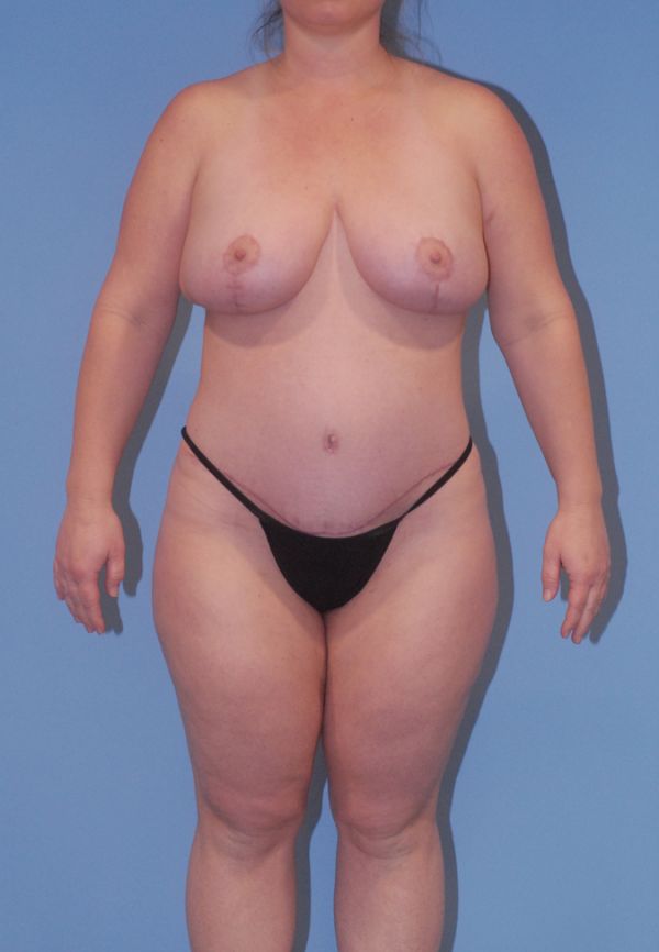 Liposuction  Before & After Image