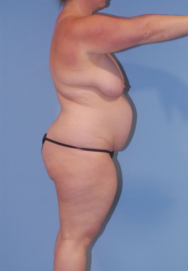 Liposuction  Before & After Image