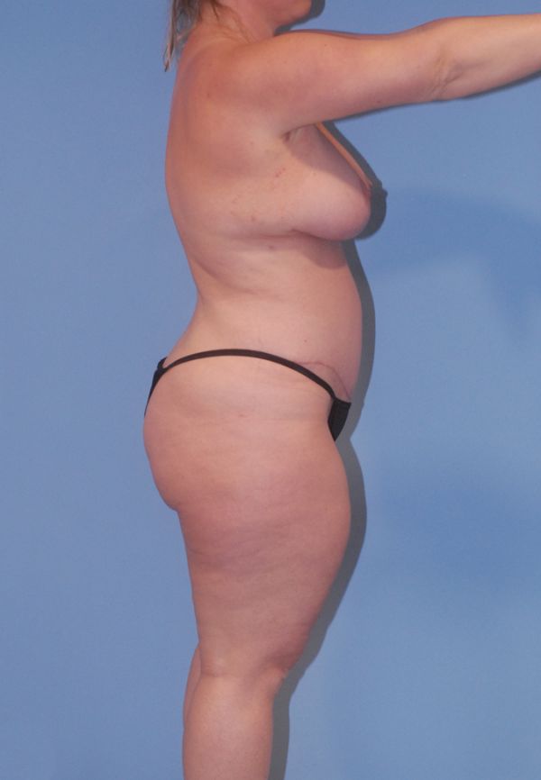 Liposuction  Before & After Image