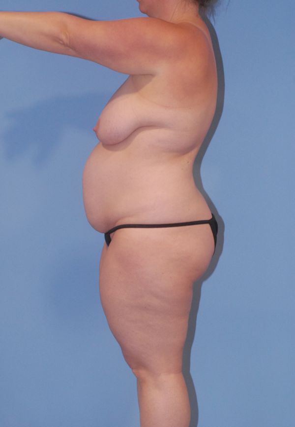 Liposuction  Before & After Image