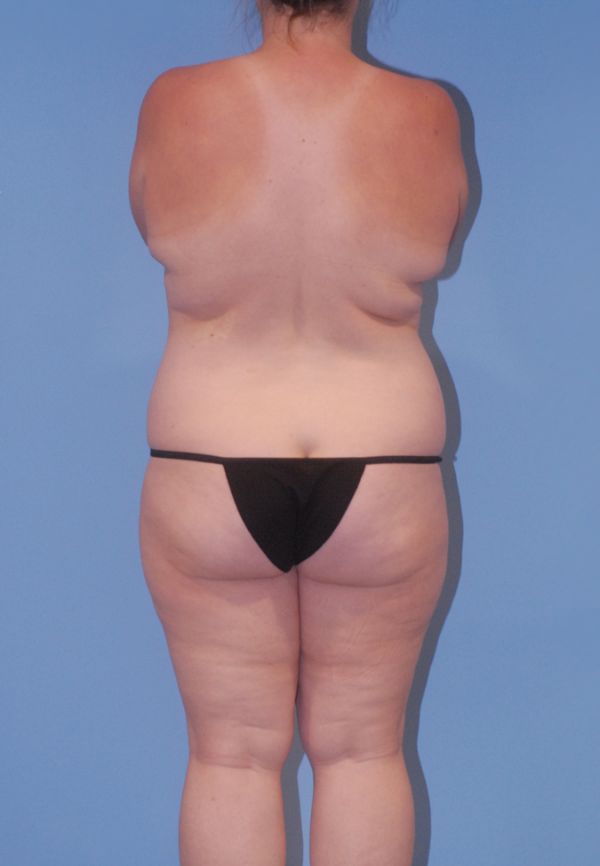 Liposuction  Before & After Image