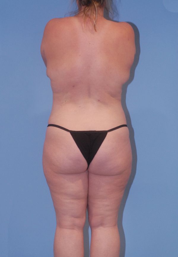 Liposuction  Before & After Image